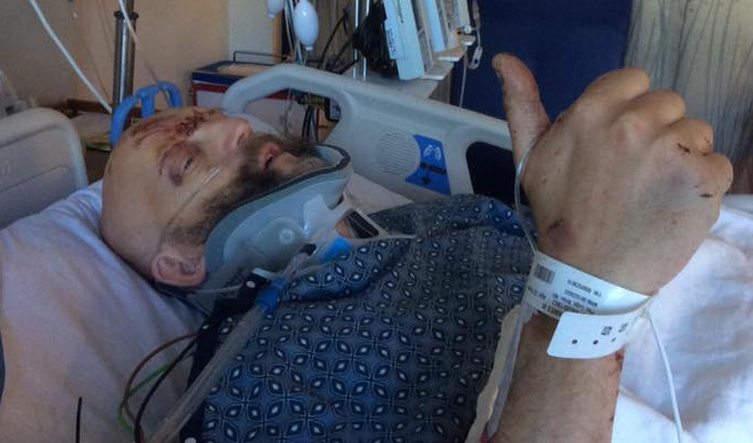 Comic Jim Tavare seriously injured in car crash | Multiple broken bones after head-on collision